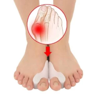 Hallux Valgus Tåspridare - Separerar Tårna - Stöd